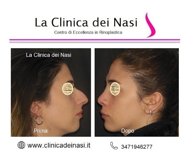 rhinoplasty italy